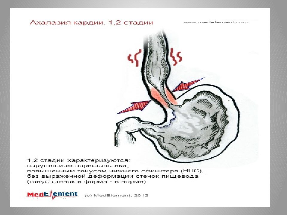 Недостаток кардии. Картина недостаточности Кардия. Недостаточность кардии. Рефлекс раскрытия кардии. Недостаточность кардии желудка что это такое.