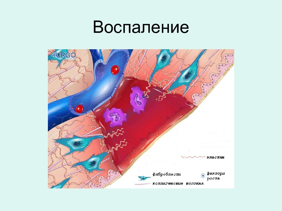 Воспалительная ткань. Соединительной ткани при воспалении. Воспаление соединительной ткани голени.