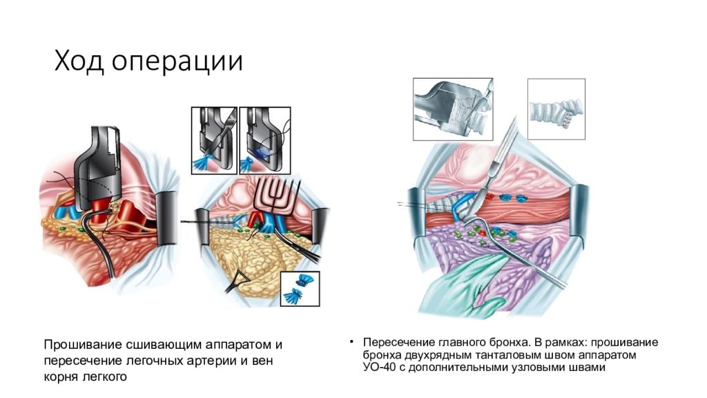 Хирургическое лечение туберкулеза презентация