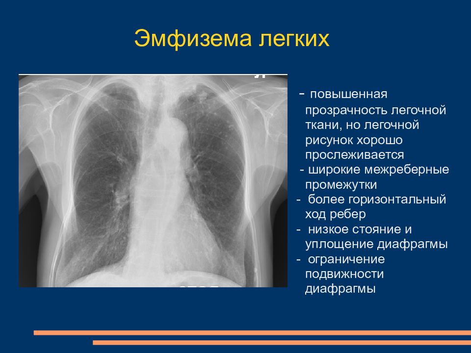 Лучевая диагностика хобл презентация