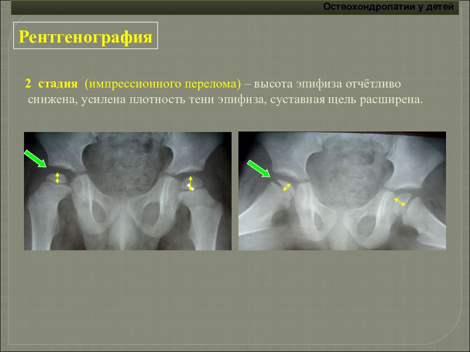 Рентгена 2. Рентгенологические стадии болезни Пертеса. Рентген болезни Пертеса 2 стадии. Болезнь Пертеса 3 стадия рентген. Болезнь Пертеса рентген стадии.