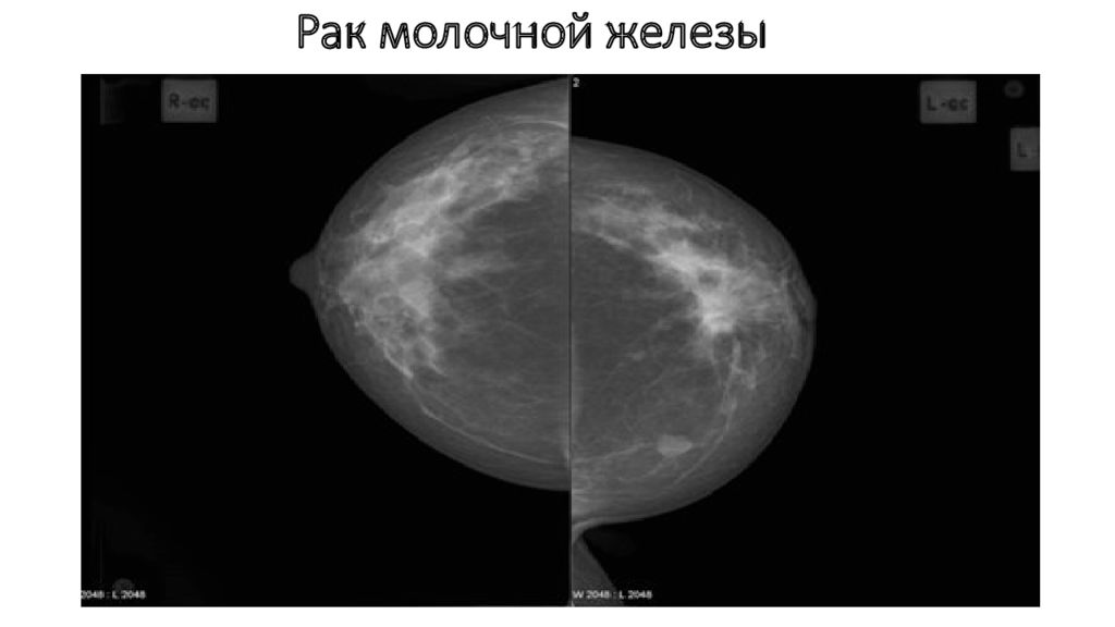 Как часто делают маммографию после 60. Маммография молочных желёз. Снимки маммографии молочных желез в норме. Билатеральная маммография. Заключение маммография молочных желез норма.