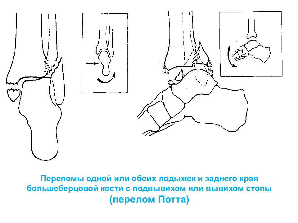 Перелом наружной лодыжки рисунок