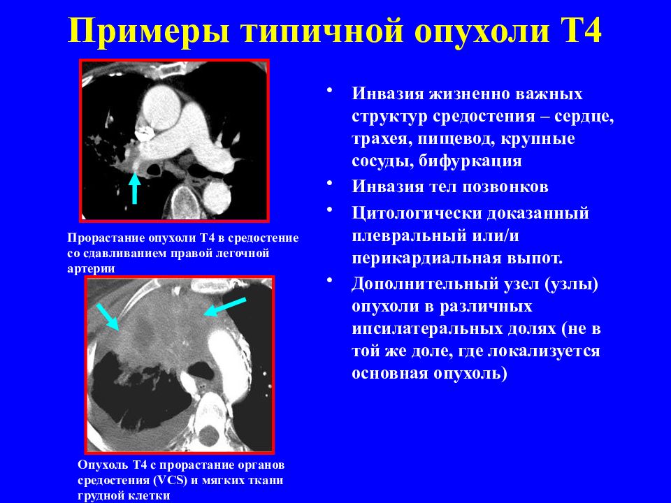 Рак трахеи тесты нмо. Опухоли средостения кт. Кт при опухоли пищевода.