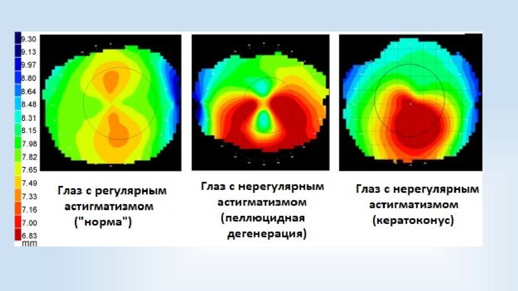 Нарушение бинокулярного зрения в результате которого происходит раздвоение изображения астигматизм