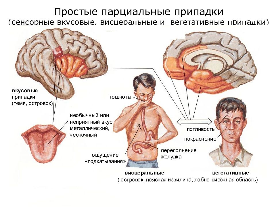 Эпилепсия неврология презентация