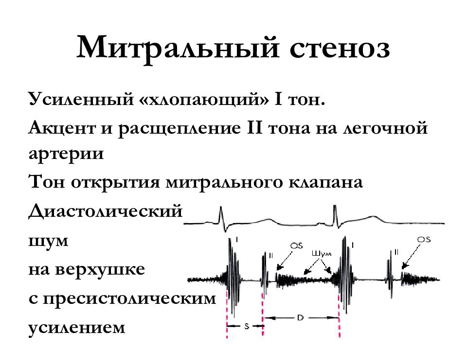 Аускультативная картина недостаточности митрального клапана