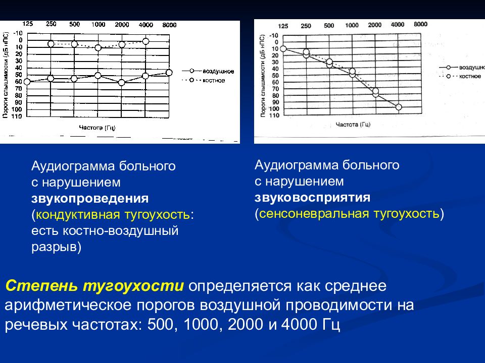 Кондуктивная тугоухость презентация