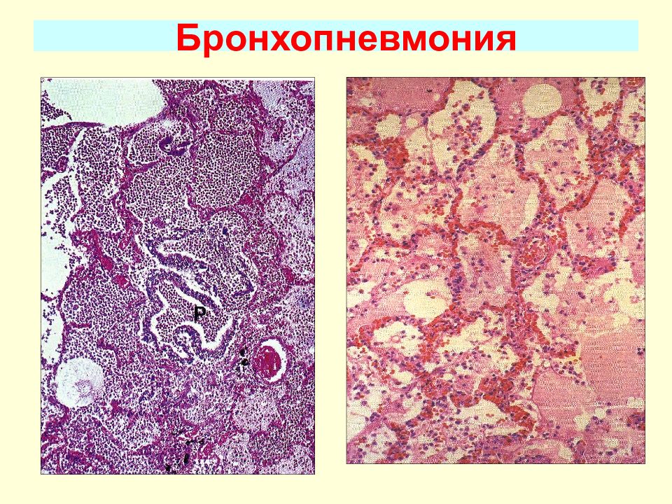 Бронхопневмония. Острые пневмонии патанатомия. Очаговая пневмония микропрепарат. Бронхопневмония патанатомия препарат. Очаговая пневмония макропрепарат.