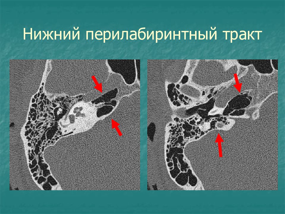 Кт височных костей. Кт анатомия сосцевидного отростка. Мезотимпанит кт височных костей. Височная кость кт анатомия. Кт анатомия височных костей.