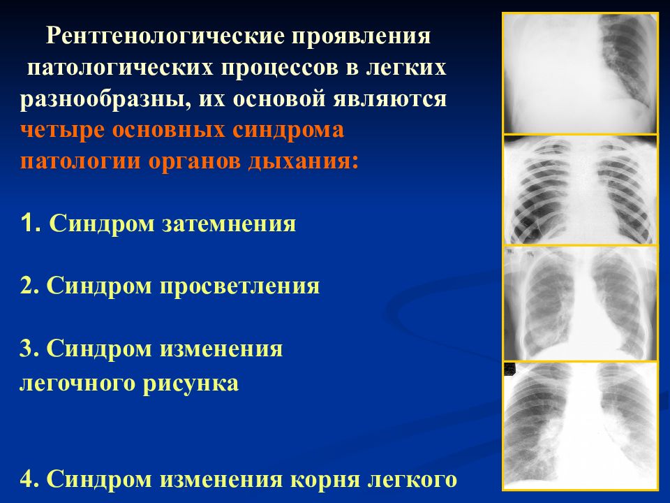 Рентгенологические признаки легких