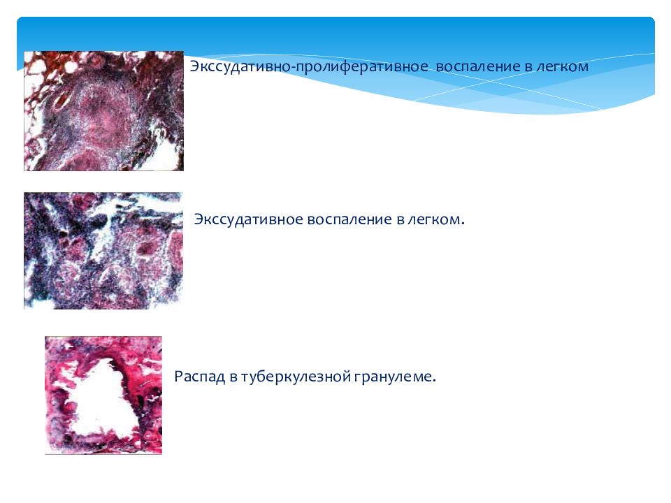 Экссудативное пролиферативное воспаление. Пролиферативное воспаление патанатомия. Пролиферативное (продуктивное) воспаление. Формы экссудативного воспаления. Экссудативное воспаление схема.