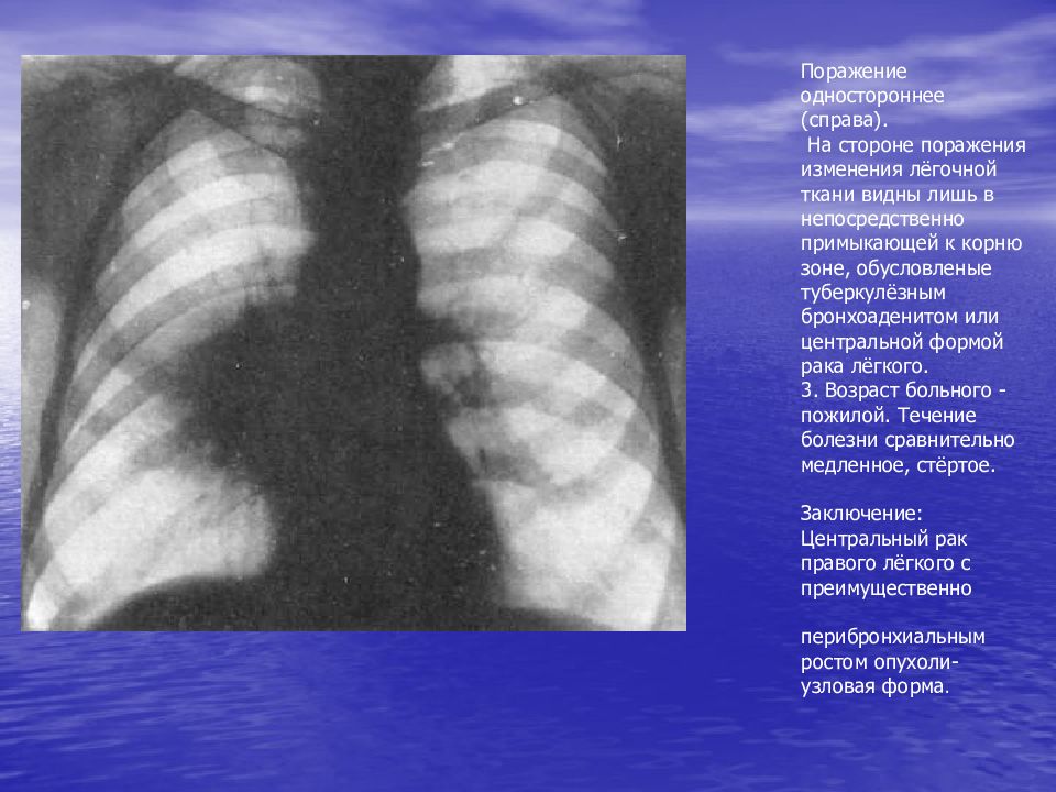 Поражение легочных тканей. Туберкулёзный бронхоаденит на рентгенограмме. Поражение легочной ткани. 10 Процентов поражения легких.