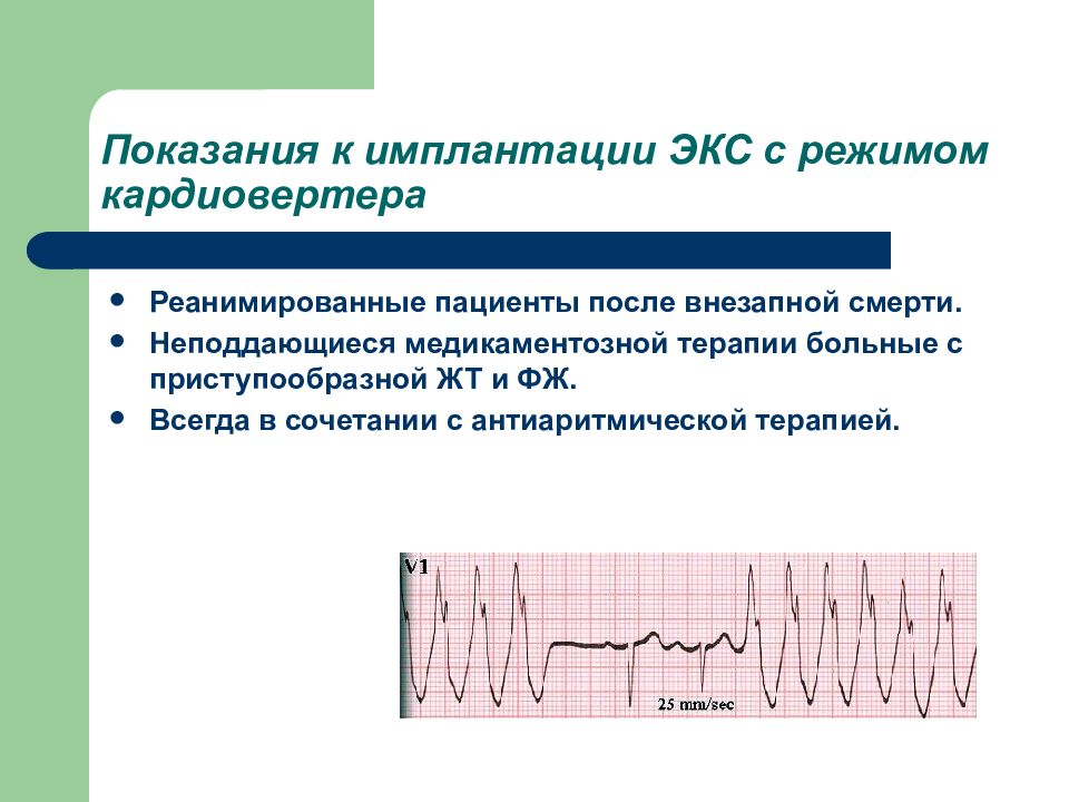 Экс пр. Показания к имплантации экс. Показания к имплантации искусственного водителя ритма. Показания для имплантации электрокардиостимулятора. Нарушение атриовентрикулярной проводимости.