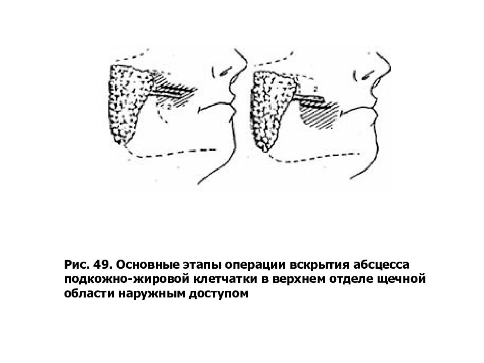 Флегмона карта смп