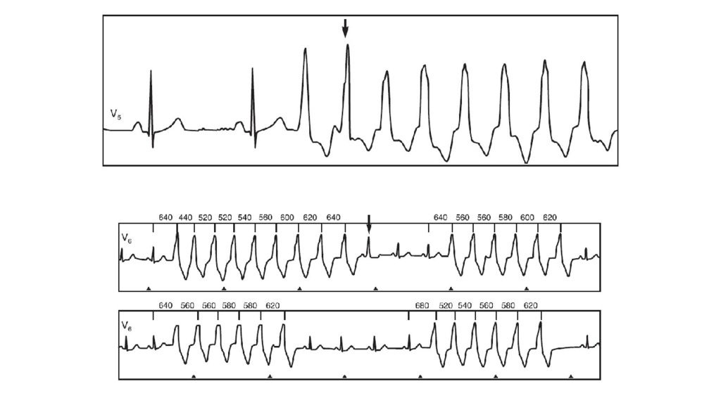 аритмии и блокады сердца. нарушения проводимости сердца классификация. экг при нарушении проводимости сердца. аритмии и блокады сердца. нарушения ритма блокады.
