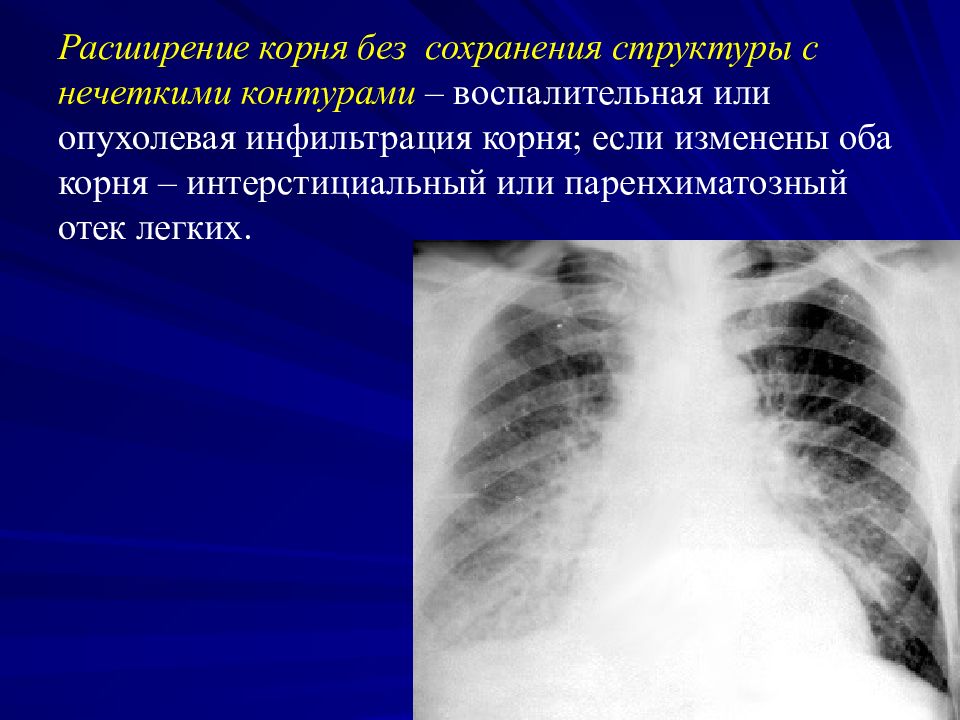 Левый корень. Одностороннее расширение корня легкого. Расширение корней легких. Легочный рисунок усилен. Инфильтрация корней легких.