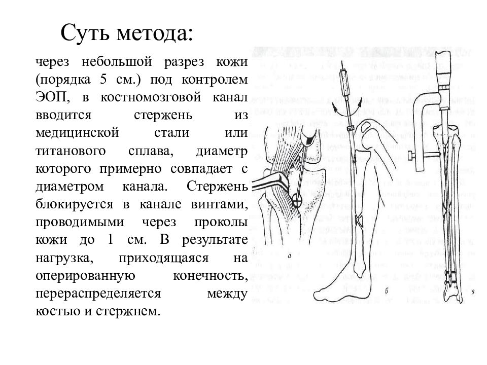 Лечение переломов костей. Сроки сращения перелома голени. Открытый перелом нижней трети голени карта вызова. Перелом нижней трети голени карта вызова. Закрытый перелом голени карта вызова.