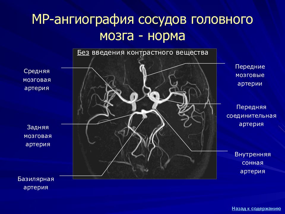 Схема сосудов головного мозга