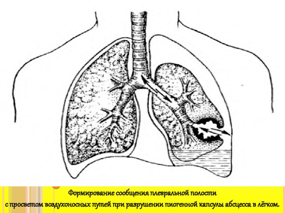 Абсцесс легкого презентация хирургия