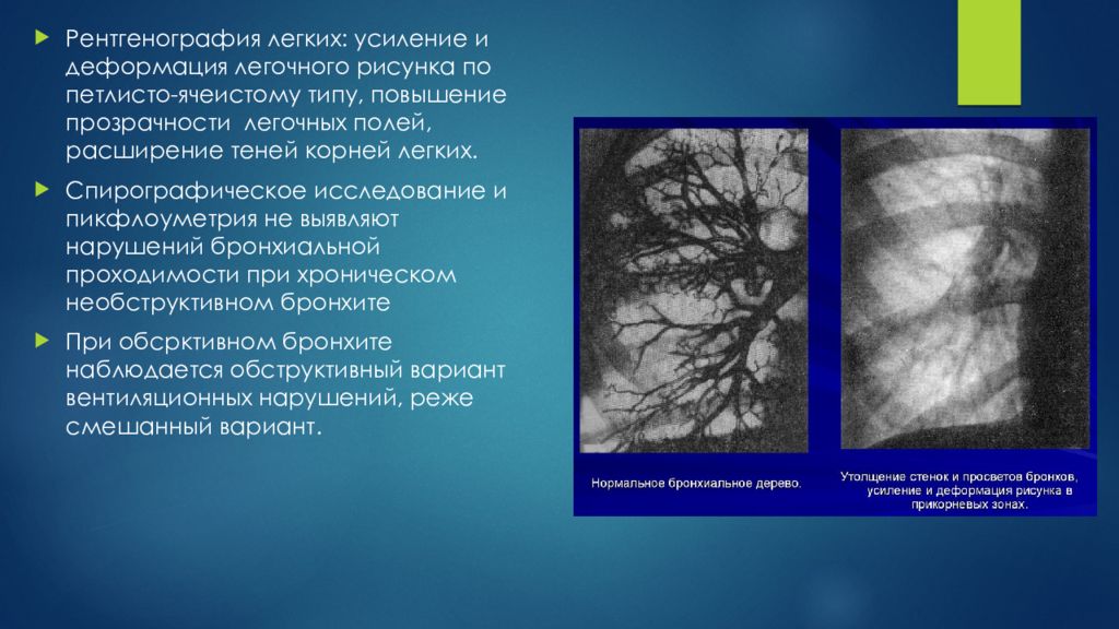 Что значит легочный рисунок усилен в прикорневых отделах