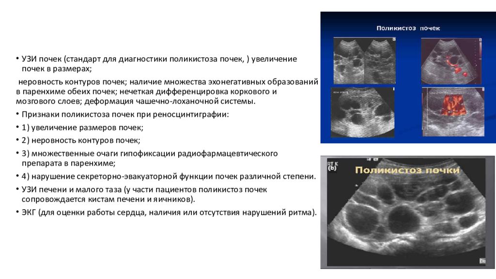 Поликистоз почек на узи. Поликистоз почек УЗИ протокол. Ультразвуковые диагностические признаки поликистоза почек.. УЗИ критерий поликистоза почек. Аутосомно-доминантный поликистоз почек УЗИ.