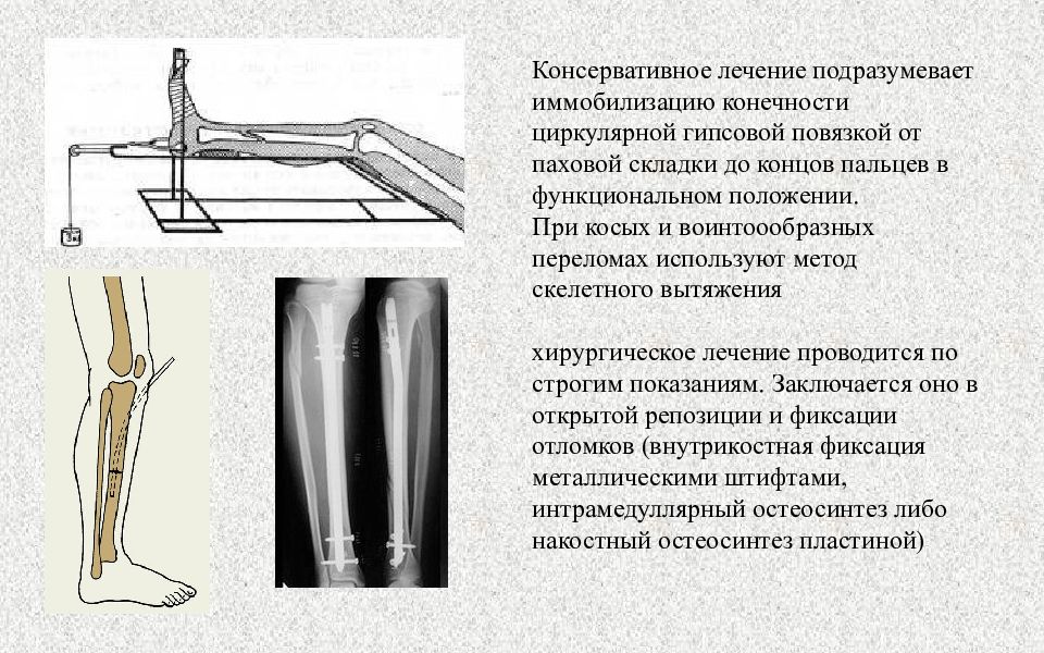 Переломы нижних конечностей презентация