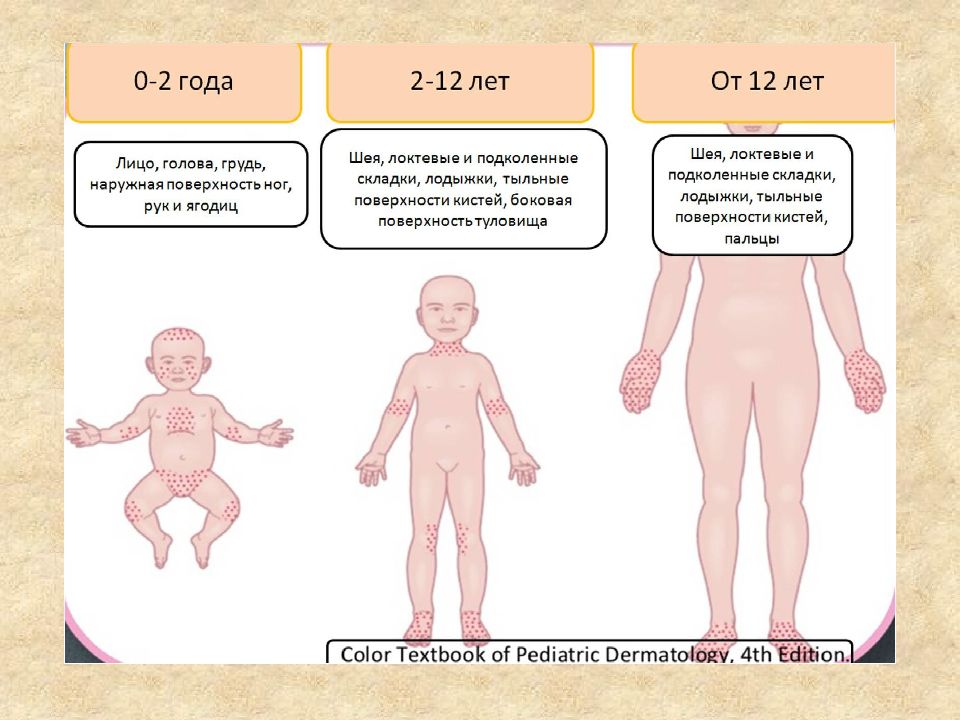 Атопический дерматит у детей презентация