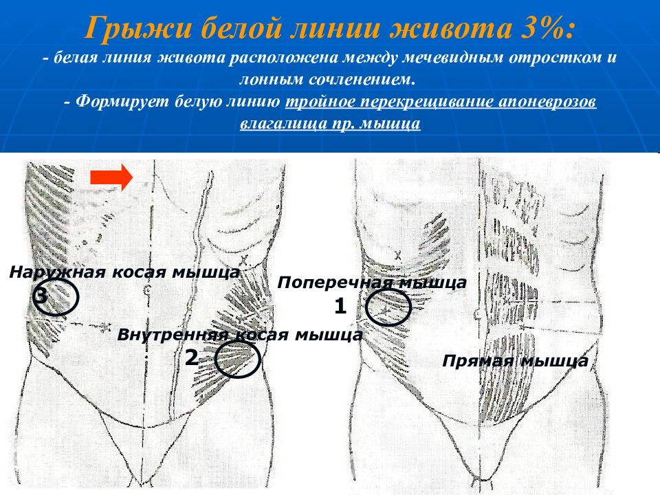 Грыжа белой линии живота карта вызова смп