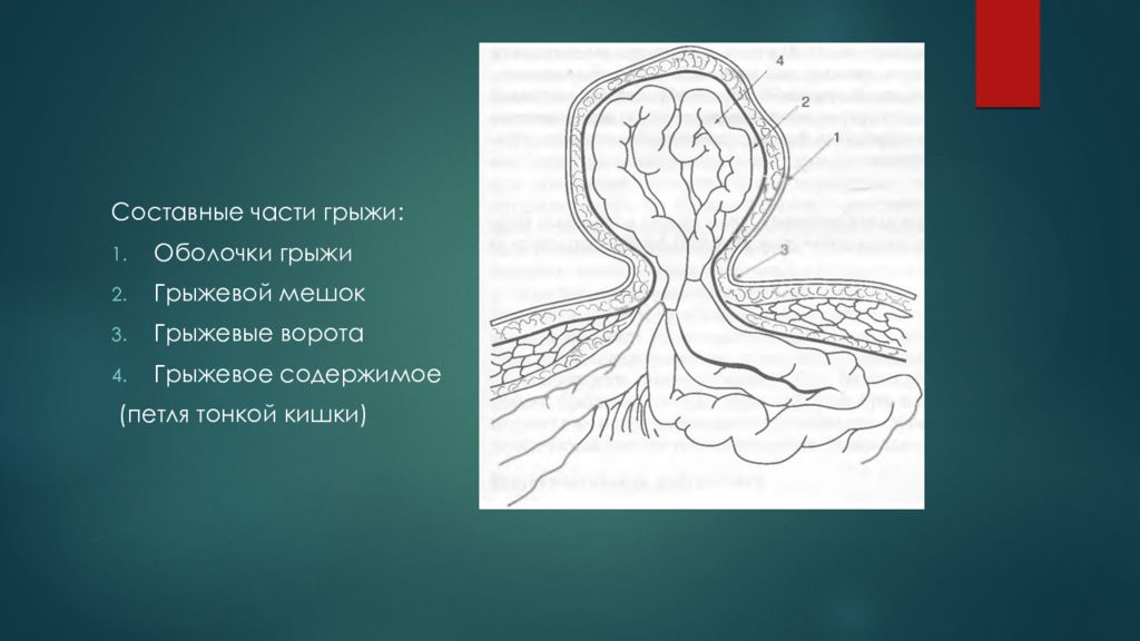Грыжевой мешок. Составныеияасти грыжи. Грыжевой мешок оболочки. Строение грыжевого мешка.