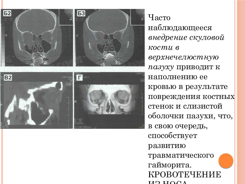 Ответы на тесты перелом скуловой кости. Перелом скуловой кости и дуги. Переломы скуловой кости и дуги презентация.