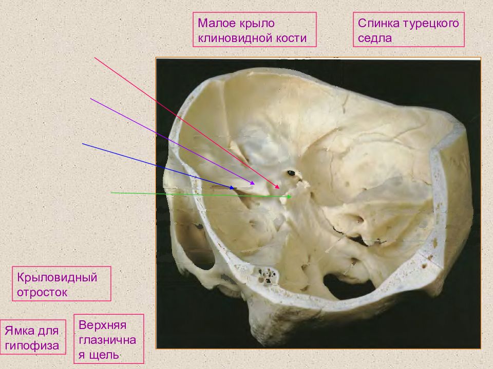 Малое крыло. Клиновидная кость верхняя глазничная щель. ПОДВИСОЧНЫЙ гребень большого крыла клиновидной кости. Височная поверхность большого крыла клиновидной кости. Турецкое седло клиновидной кости.