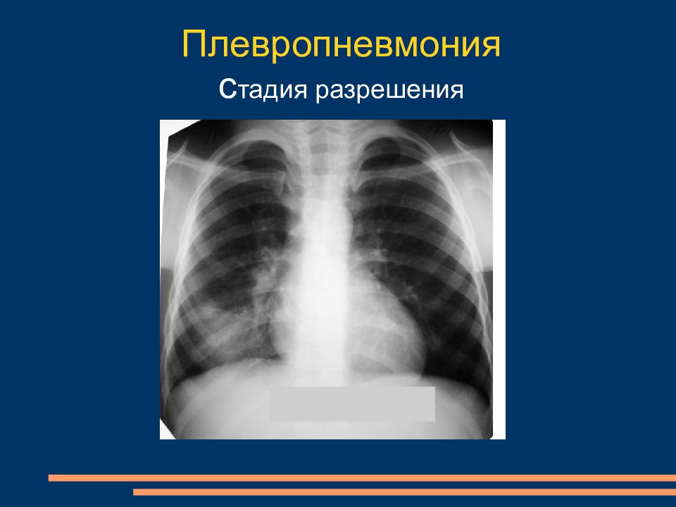 Плевропневмония. Плевропневмония на рентгенограмме. Плевропневмония диагноз. Плевропневмония рентген.