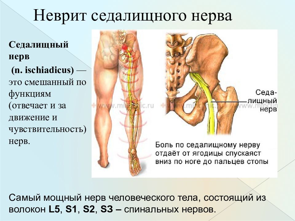 Ишиас это. Поражение седалищного нерва симптомы. Защемление седалищного седалищного нерва симптомы. Невропатия седалищного нерва. Ишиас - защемление седалищного нерва.