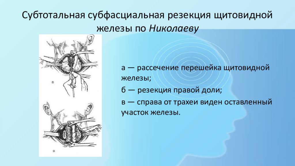 Резекция щитовидной железы. Субтотальная резекция щитовидной железы. Субтотальная субфасциальная резекция щитовидной железы по Николаеву. Резекция щитовидной железы по Николаеву. Субтотальная резекция молочной железы.