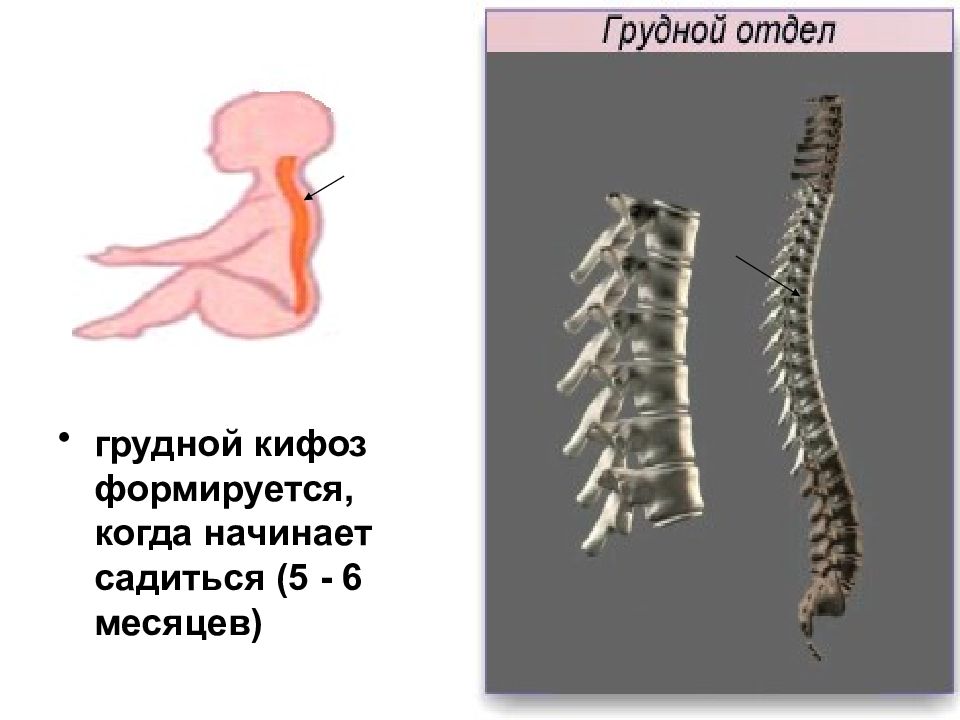 Грудной кифоз. Грудной кифоз формируется. Угловой кифоз.