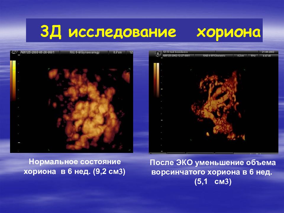 Многоплодная беременность презентация