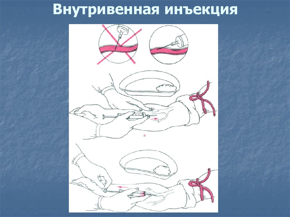 Алгоритм проведения внутривенной. Техника внутривенной инъекции. Введение внутривенной инъекции. Техника введения внутривенной инъекции.