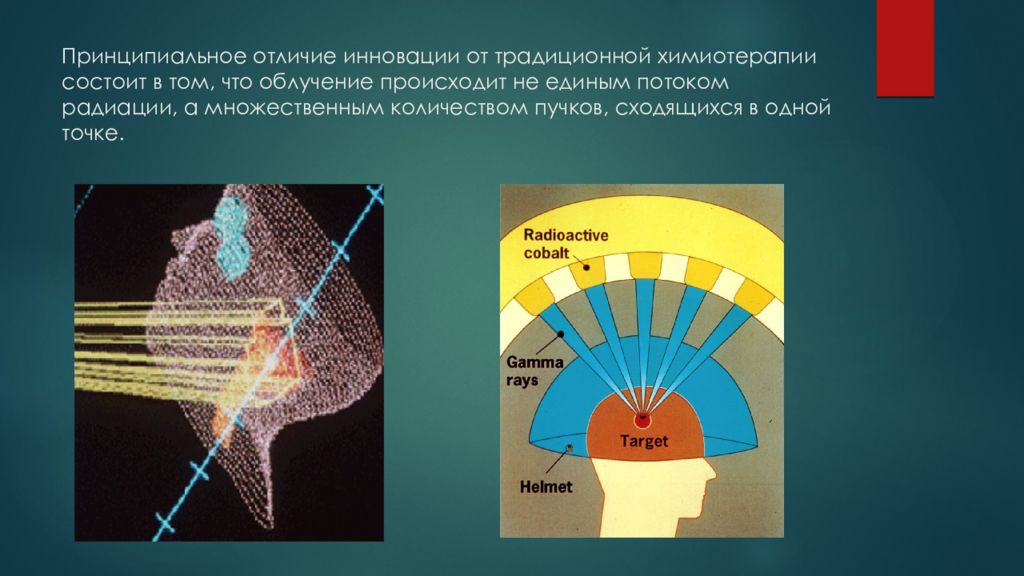 Гамма презентации. Гамма нож доза облучения. Гамма нож принцип. Гамма нож схема. Гамма нож принцип действия.