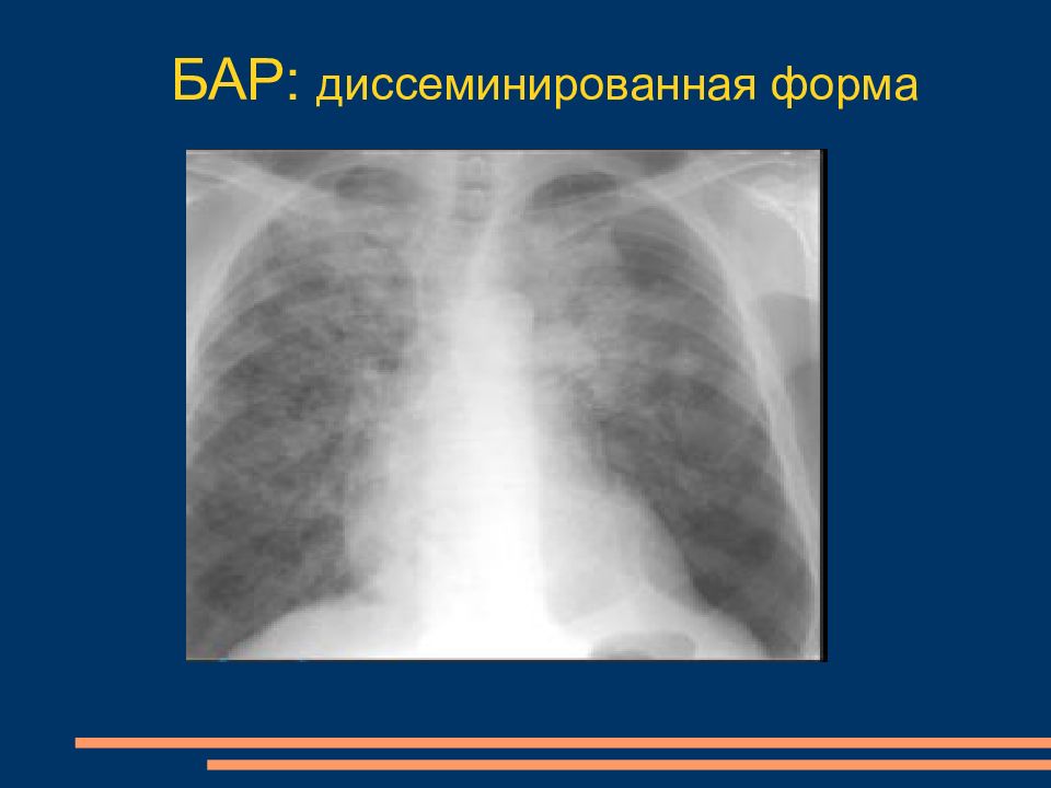 Лучевая диагностика рака легкого презентация