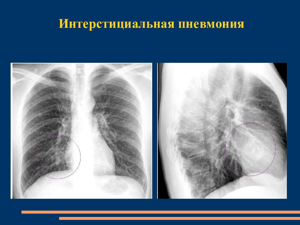 Интерстициальный легочный рисунок. Интерстициальная пневмония рентген. Интерстициальная пневмония у детей рентген. Интерстициальная пневмония на рентгенограмме. Плевропневмония двусторонняя.