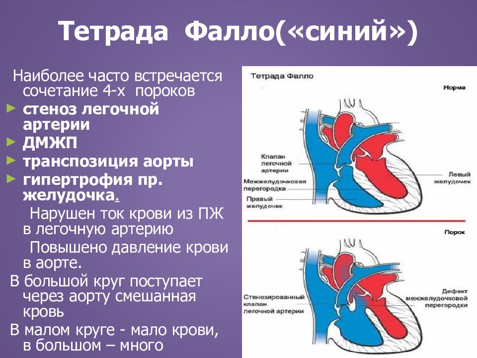 Врожденный порок сердца тетрада фалло презентация