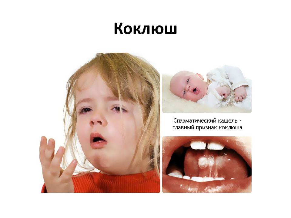 Коклюш у детей фото