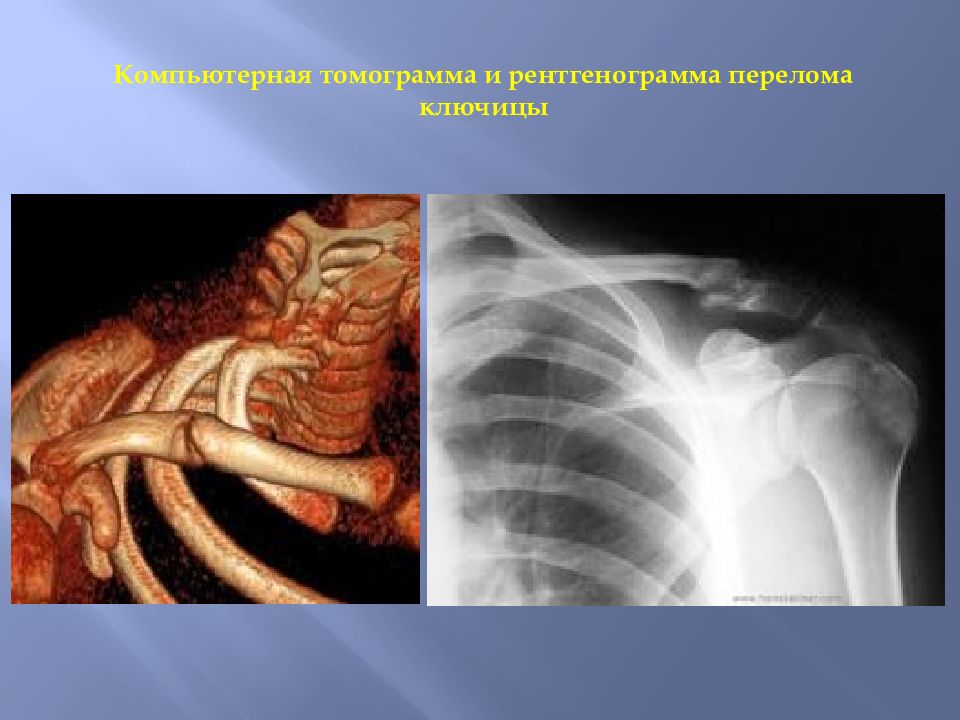 Переломы лопатки презентация