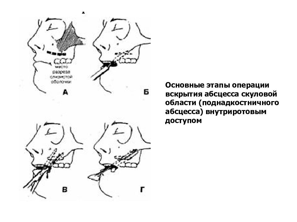 Вскрытие флегмон и абсцессов. Поднадкостничный абсцесс верхней челюсти.