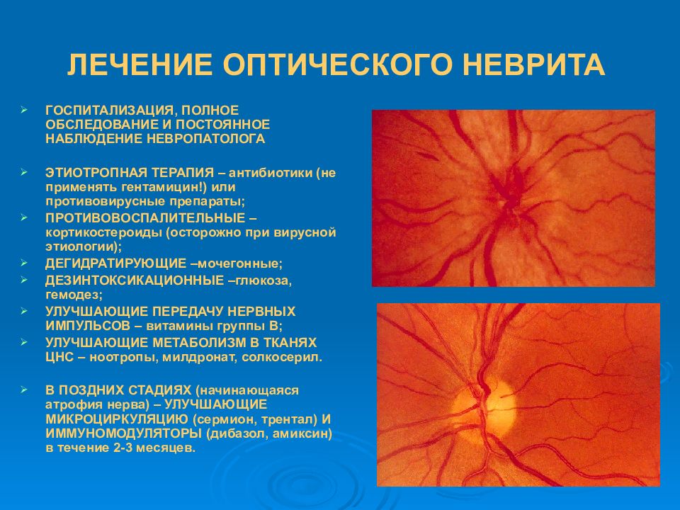 Лечение глазного нерва. Ретробульбарный неврит зрительного. Ретробульбарный неврит (папиллит). Неврит зрительного нерва глазное дно. Неврит глазного нерва ретробульбарный.