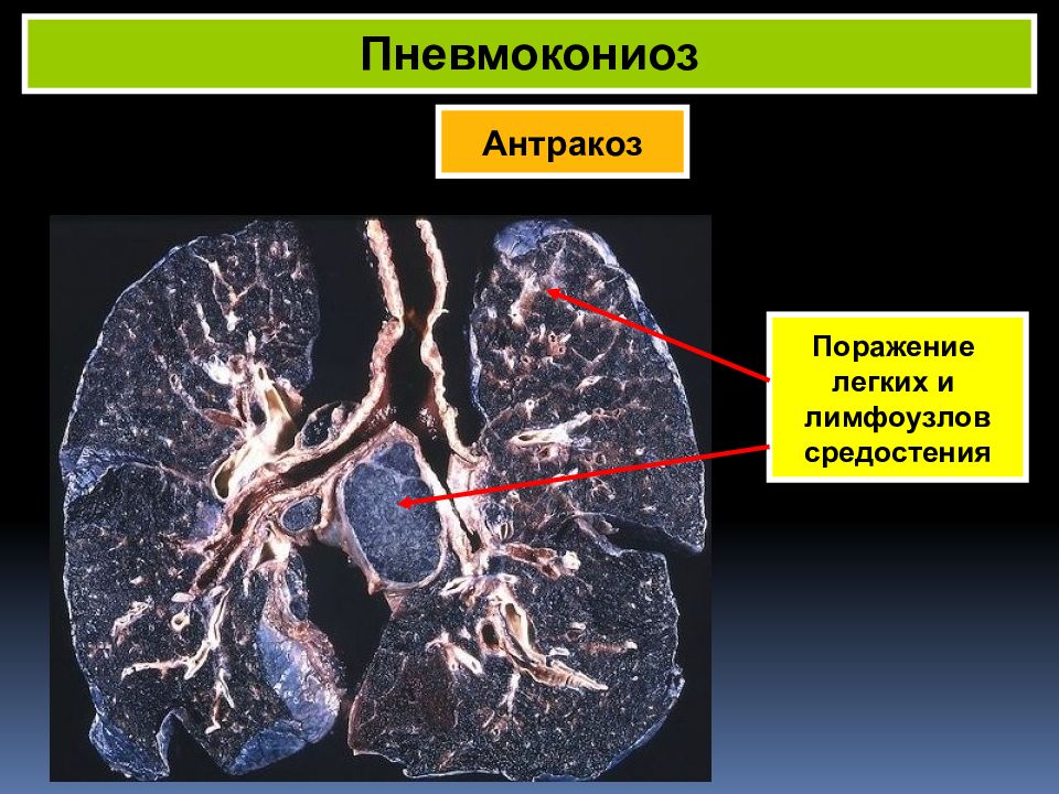 Пневмокониоз легких. Патологический Антракоз легких. Антракоз лимфатического узла.