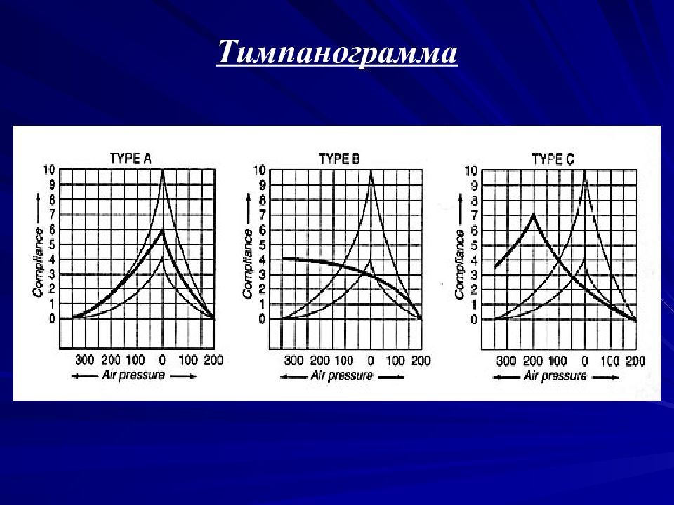 Типы тимпанограмм