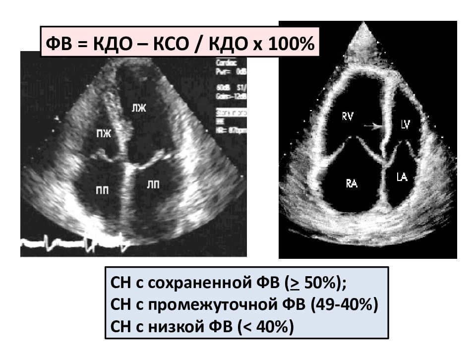 Ксо сердца. КСО ЭХОКГ. Расчет КДО И КСО при Эхо сердца. Волосатое сердце ЭХОКГ. Таблица КДО И КСО фракция выброса.