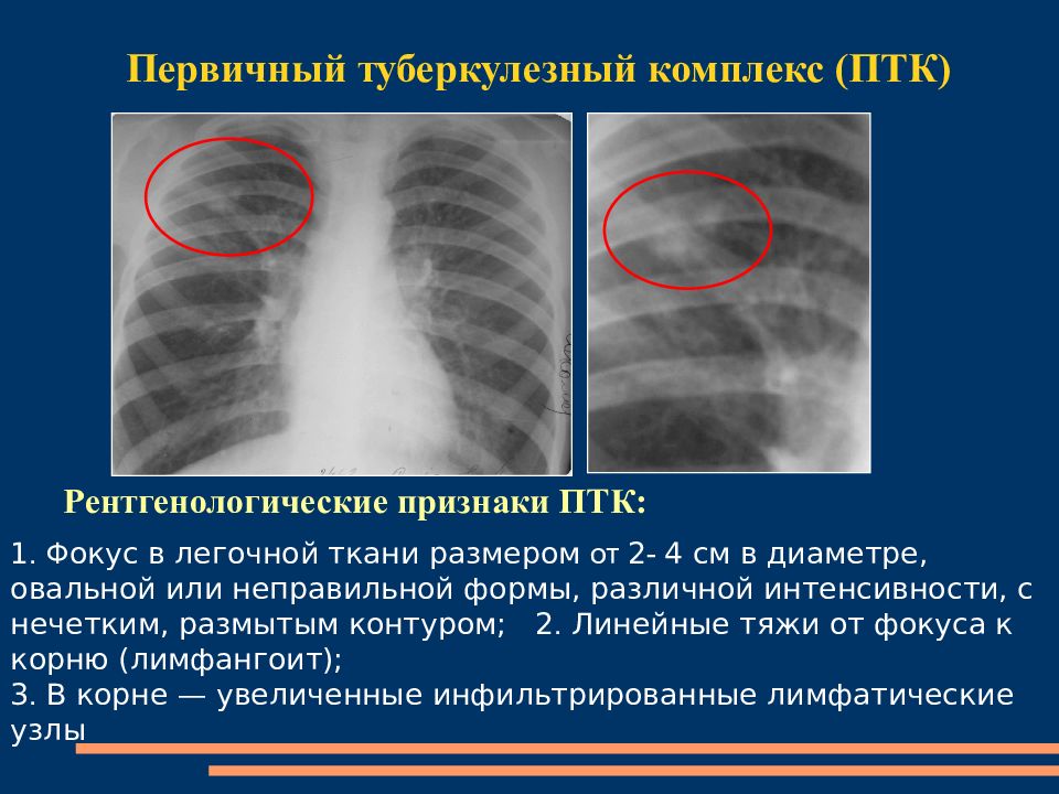 Гон легких. Первичный туберкулезный комплекс на рентгенограмме. ПТК туберкулез рентген. Первичный туберкулезный комплекс у детей рентген. Первичный туберкулезный комплекс фаза биполярности.